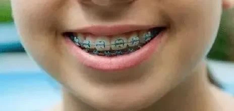 Dječja ortodontoka: Što trebam učiniti ako ortodontske zagrade otpadnu?